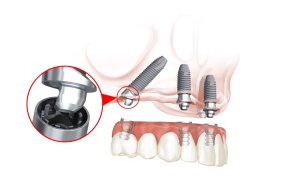 All-on-4® Dental Implants top view
