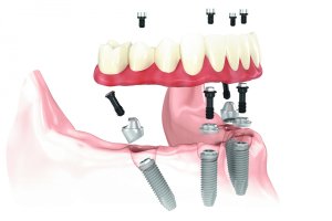 All-on-4® Dental Implants bottom view