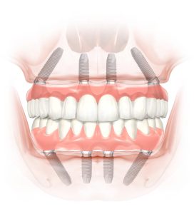 All-on-4® Dental Implants front view