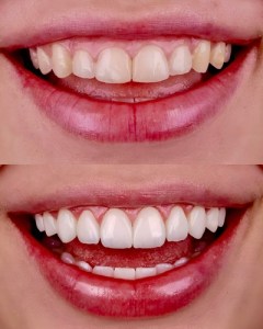 before & after gummy smile